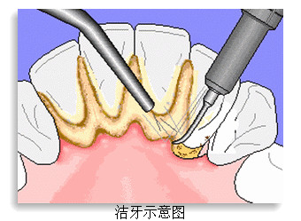 桂林路牙结石洗牙要多少钱_健康_南阳新闻_南