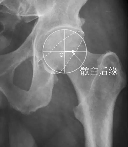 髋臼过深,过度包容:髋关节中心边缘角(center-edge angle, cea)>39