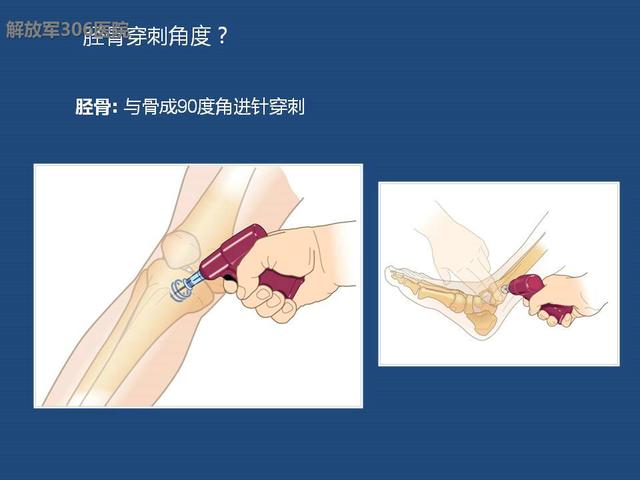 新型急救方法骨髓腔急救输液系统