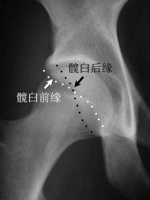 髋臼过深,过度包容:髋关节中心边缘角(center-edge angle, cea)>39