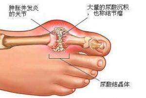 痛风罕见的4个错误熟悉