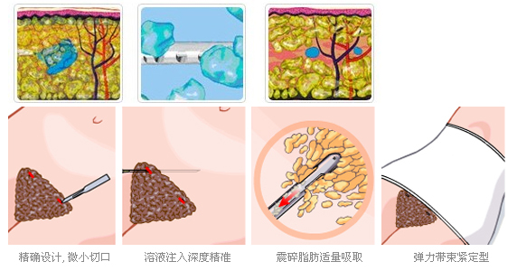 且皮肤弹性要好,抽吸脂肪后局部皮肤有很好的回缩弹力,才可能