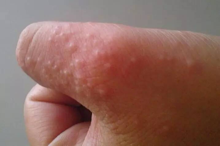 汗疱疹4接触肥皂或洗衣粉后,出现无缘无故手脱皮,一般脱皮从手指开始