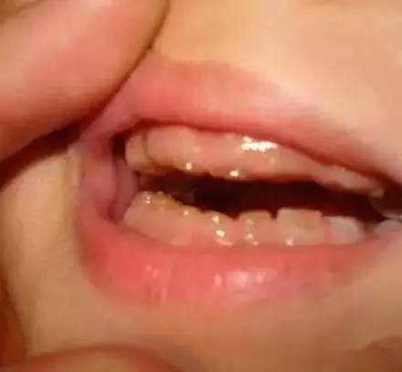 刚8岁,男孩的牙齿全部掉光光了!真的别再让孩子这样做了