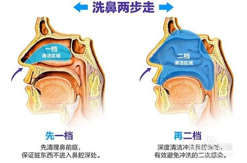 谁说中医治鼻炎不靠谱? 遇到一位好中医鹊后通