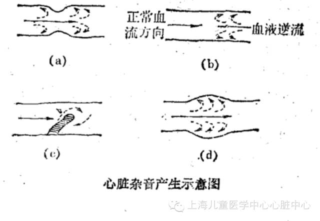 血液流经漂动的乳头肌,腱索周围就形成漩涡而产生杂音