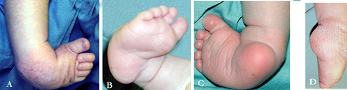 出生后即出现单侧或双侧足部程度不等之畸形,足部呈踝关节跖屈位,内翻