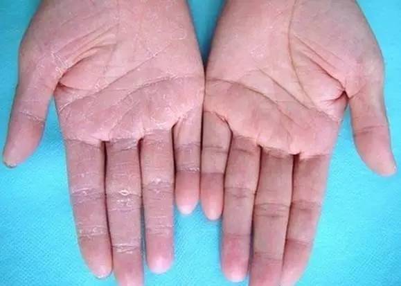 手癣都是因为真菌感染所导致的,同脚癣一样,手癣会导致双手脱
