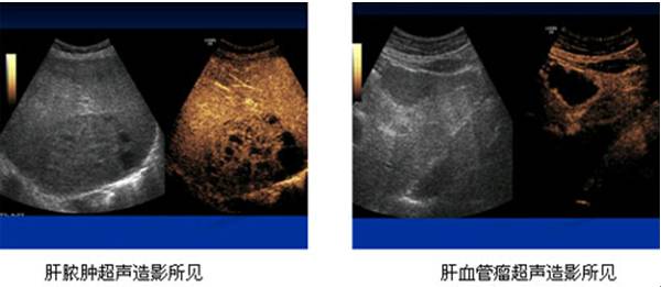 二,纳米超声造影剂"直达"肿瘤说人话,就是传统消灭癌细胞的治疗方法