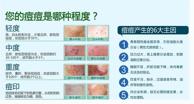 脸上长痘的原因有哪些?怎样预防痘痘疯长?