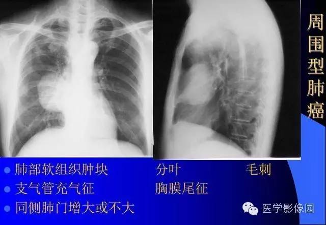 收藏了,x线平片肺部常见病总结!