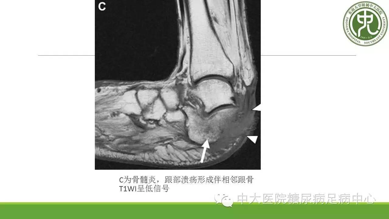 糖尿病足影像检查方法选择及诊断要点