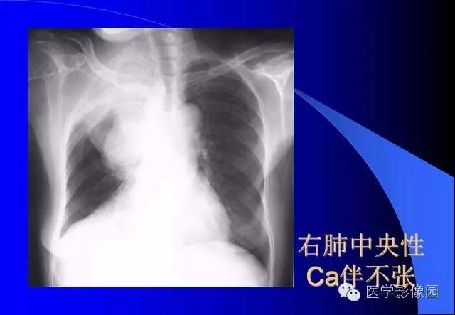 收藏了,x线平片肺部常见病总结!