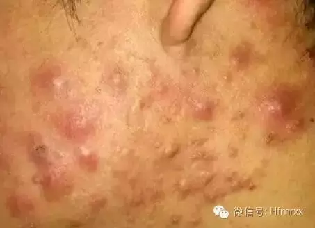 痘痘发不出来怎么办