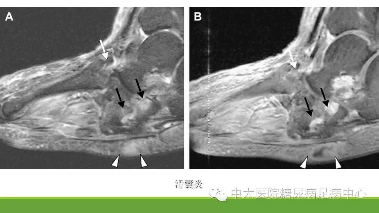 白箭头表示骨碎片,黑箭头表示软骨下囊变,三角表示骰骨滑囊炎溃疡合并