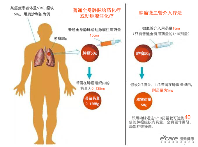 小苏打饿死癌细胞?还是要靠血管介入治疗!