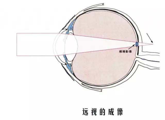 科普:秒懂什么是近视,远视,散光,老花眼 你一定不知道