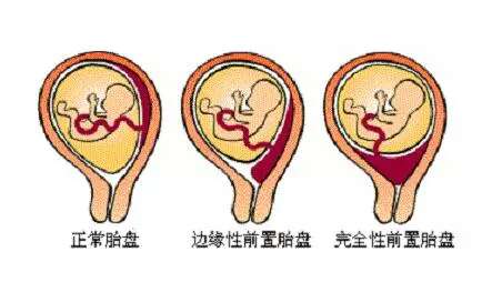 胎盘前置日常护理注意事项