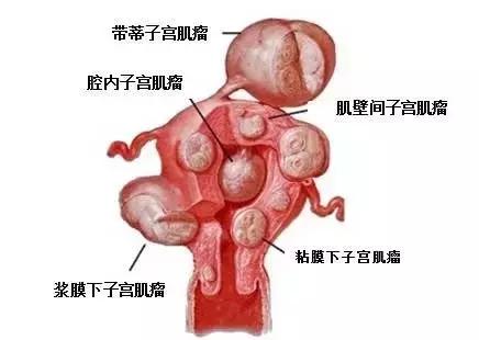 子宫肌瘤怎么吃红参