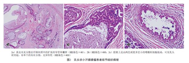 什么是乳头状小汗腺腺瘤?