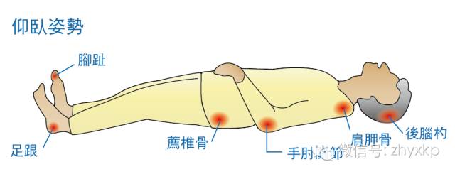 仰卧好发于:枕骨粗隆,肩胛骨,肘,脊椎体隆突处,骶尾部,足跟.