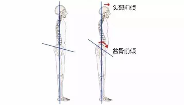 骨盆前倾 骨盆前倾是骨盆位置偏移的病态现象,较正确的骨盆位置一般