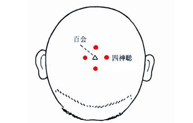 按摩方法:被按摩者坐位,按摩者用双手的食指和中指分别对准四神聪的4