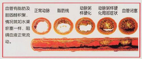 动脉粥样硬化是全身性疾病