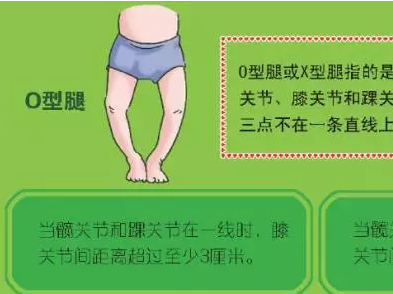 宝宝如果是o型腿,应该怎么办呢?