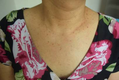 慢性砷中毒引发的皮肤病--砷角化病