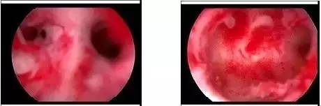 【中六生殖宫腔精细手术】宫腔粘连的新出路