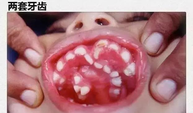 揭秘孩子是如何长出两层牙齿的?