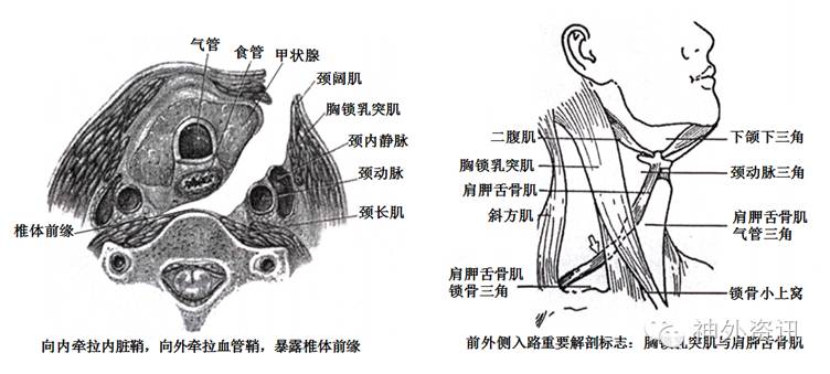 切除后纵韧带彻底减压脊髓,选择合适大小钛笼,其内夯实同种异体骨