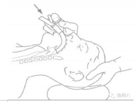 腔部位直到感觉到稍有阻力即为正确位置;78托起下颌,将喉罩沿着硬腭
