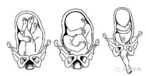 常见的胎位不正有三种: 臀位,横位和斜位.