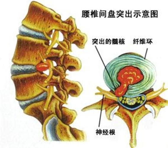 腰椎间盘突出压迫神经有什么危害呢