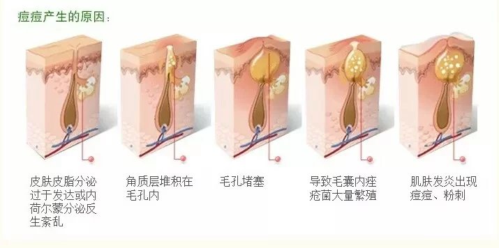 是一种毛囊皮脂腺结构的慢性炎症疾患,主要发生于颜面及胸背等处,体现