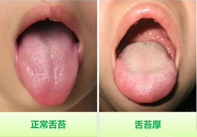 积食舌苔厚如下图: 阴虚舌苔少或地图舌如下图: 阴虚舌苔少或地图舌