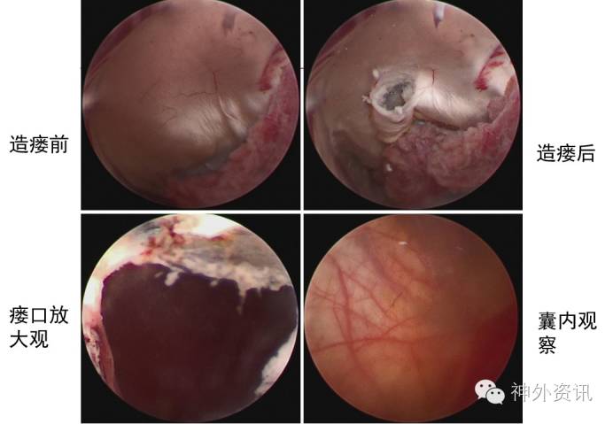 【罕见】病例讨论| 华山脑胶质瘤mdt tumor board case review xv