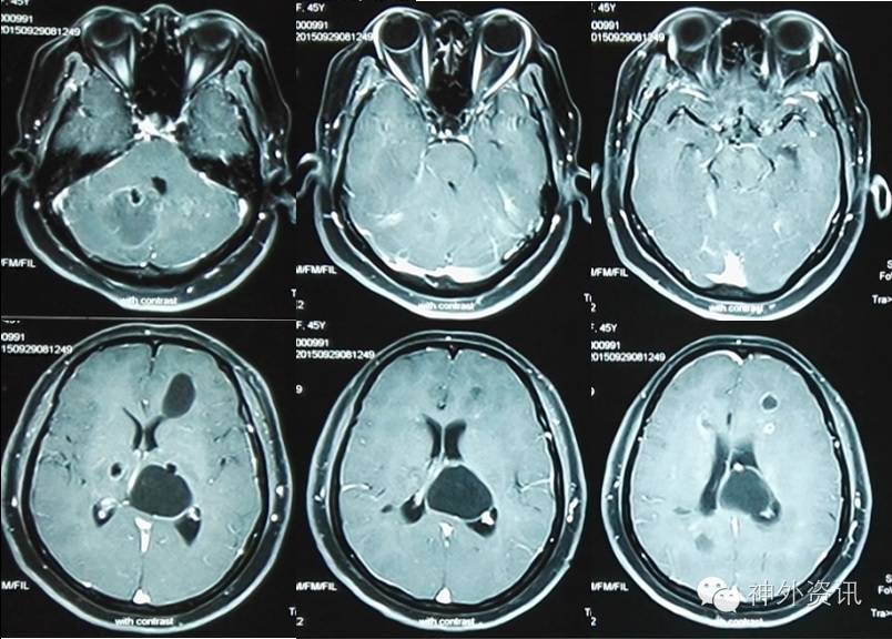 罕见病例讨论华山脑胶质瘤mdttumorboardcasereviewxv