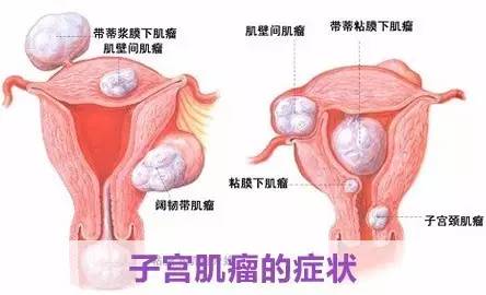 【女人】蓝瘦,香菇,小腹隆起不是怀孕就是胖?