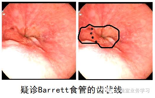 barrett食管相关知识