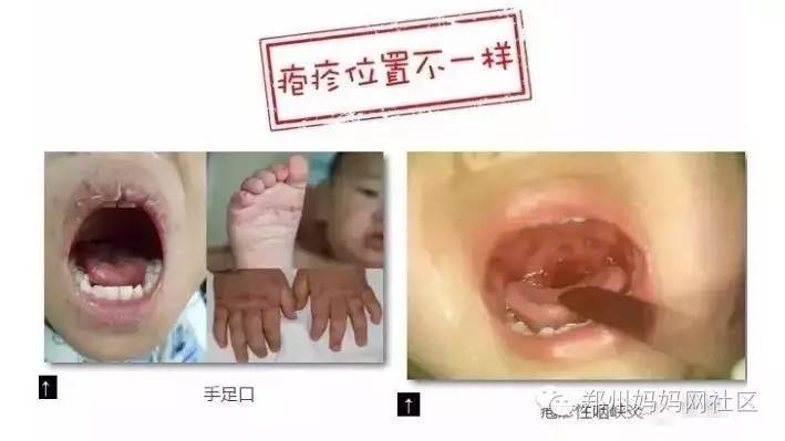 不小心误带了水痘病人口罩_水痘图片初期