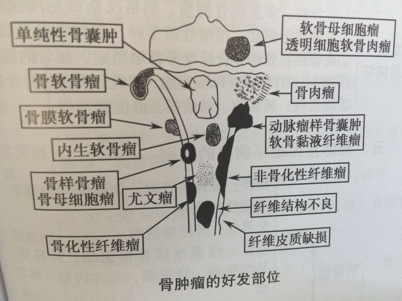 e诊断:骨肿瘤的好发部位