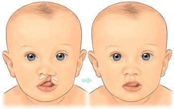 孩子兔唇影响一生,如何预防孕妈咪该做到这些