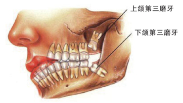 拔牙和矫正牙齿哪个可以瘦脸?看完这个你就明