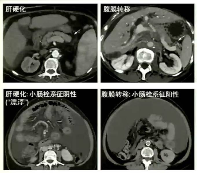 胃癌腹膜转移诊断攻略