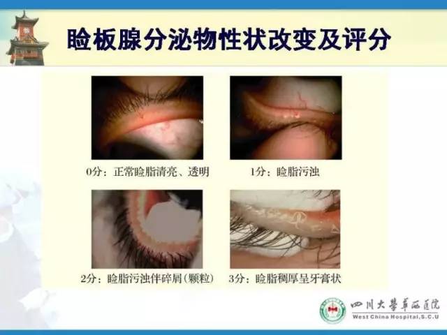 图5. 睑板腺分泌物性状改变