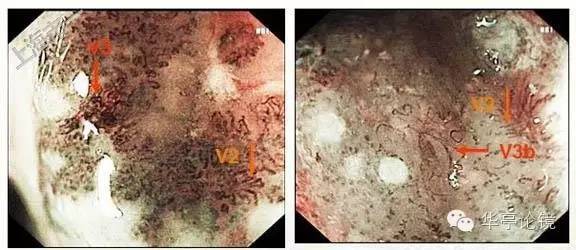 6个精彩病例带你领略早期食管癌的内镜下诊治