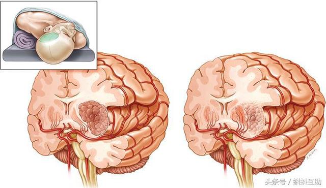 脑胶质瘤完整切除术--胶质瘤的最佳治疗方式